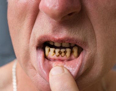 Meth Mouth: How Methamphetamine Use Affects Dental Health- Mooresville Dental Care