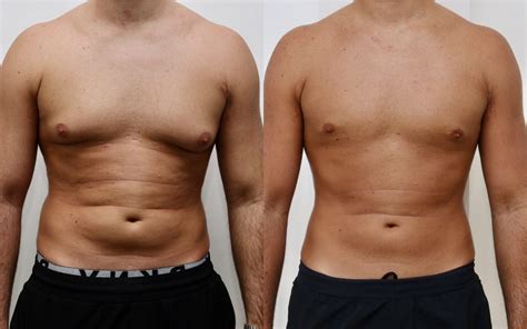 Gynecomastia Before After Gallery, 54% OFF