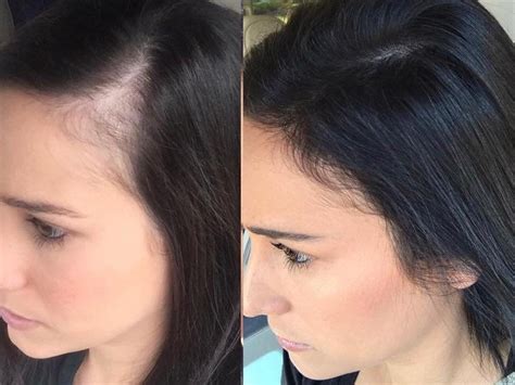 Aggregate 119+ hair loss treatment wikipedia super hot - tnbvietnam.edu.vn