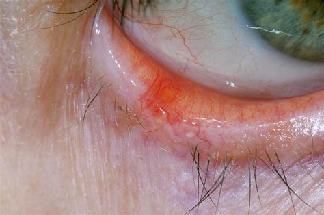 Lesion On The Lower Eyelid Photograph by Dr P. Marazzi/science Photo ...