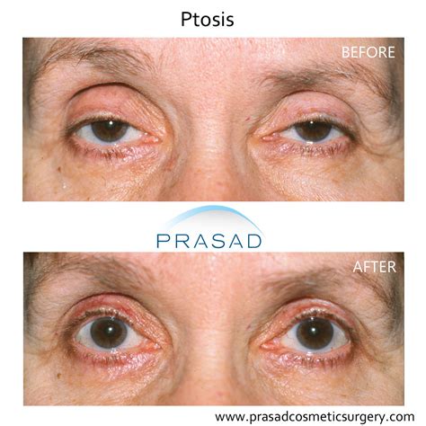 Ptosis Surgery Before And After Photos | Amiya Prasad MD FACS