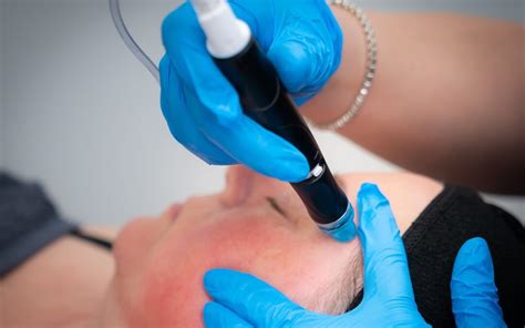 Hydrafacial vs Microdermabrasion - Which Is Better? - Freyja Medical