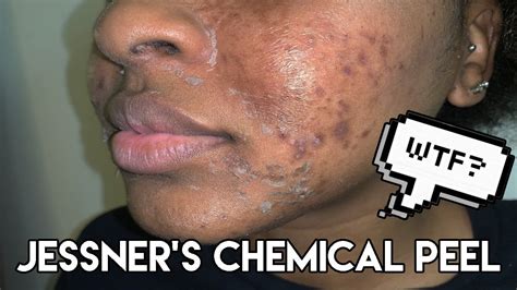 CHEMICAL PEEL | PROCEDURE | PEELING | BEFORE & AFTER | JESSNER CHEMICAL PEEL | KENSTHETIC - YouTube