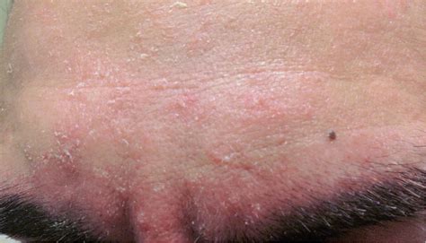 Diagnosis and Treatment of Seborrheic Dermatitis | AAFP