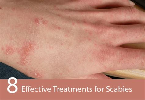 Scabies Causes Symptoms Treatment Pictures Images - vrogue.co