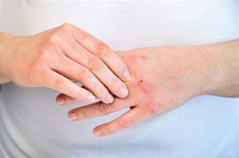 Atopic Dermatitis (Eczema): Causes, Symptoms, Treatments and Medications