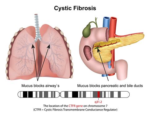 Cystic Fibrosis: Causes, Symptoms, Diagnosis and Treatment - Online ...