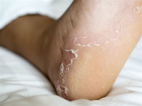 What Causes Itchy Feet? 4 Common Causes - JAWS podiatry