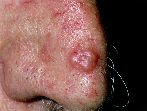 Bump On Nose Skin Cancer