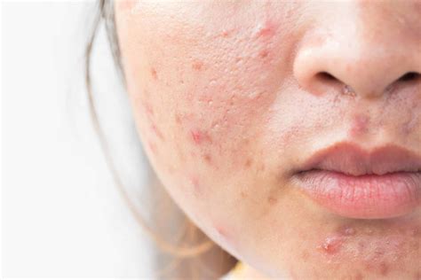 Natural acne scar treatment: Can I get rid of acne scars naturally? - Stratum Clinics