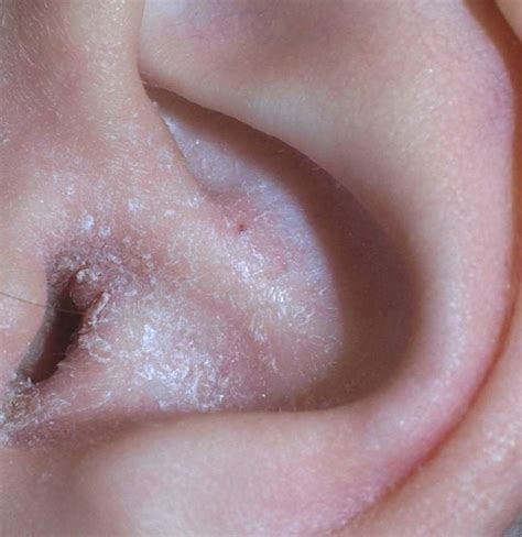 Ear eczema: Symptoms, causes, and treatment