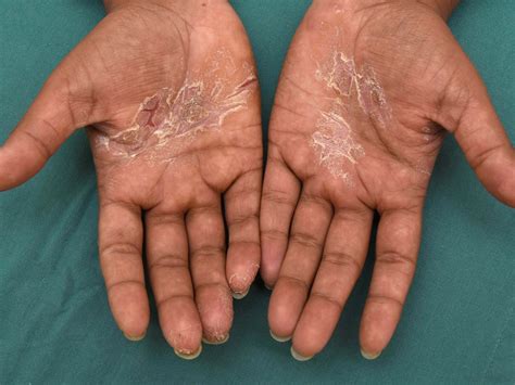 Cureus Dyshidrotic Eczema: A Common Cause Of Palmar, 42% OFF