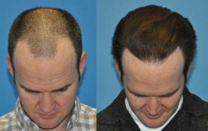 Norwood Class IIIv - 3000 FUE Grafts - Case Study - Carolina Hair Surgery