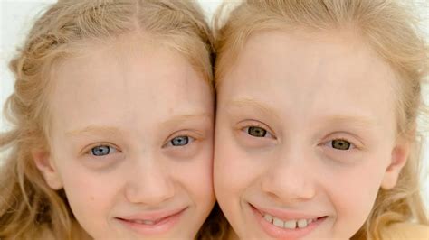 Can Twins Have Different Eye Colors? (Yes/No)