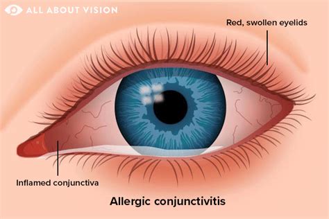 Types of Conjunctivitis (Pink Eye) - All About Vision