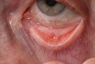 Conjunctival cyst - Stock Image - C054/9653 - Science Photo Library