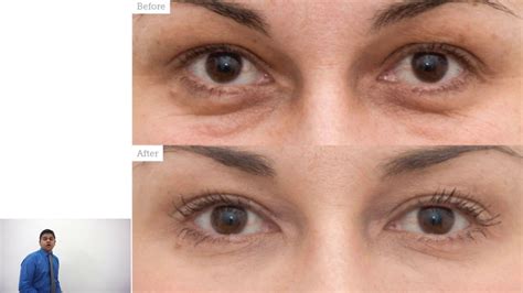 List Of Cat Eye Surgery Before And - Anna Ford
