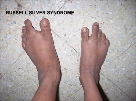 Causes of Russell Silver Syndrome Archives | Dr. Vikram Chauhan's Blog