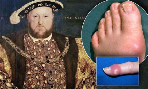 'Disease of kings' on the rise as more people get gout because of increase in obesity | Daily ...