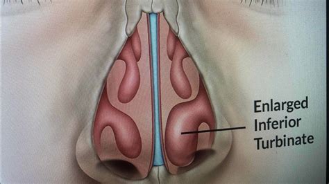 Septoplasty and Turbinate reduction - YouTube