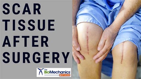 Scar Tissue After Surgery and How It Affects Movement - YouTube