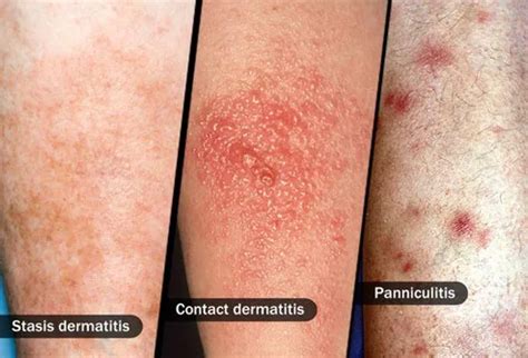 Cellulitis Rash Stages