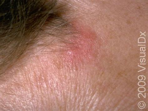 Discoid Lupus Erythematosus Condition, Treatments and Pictures for ...