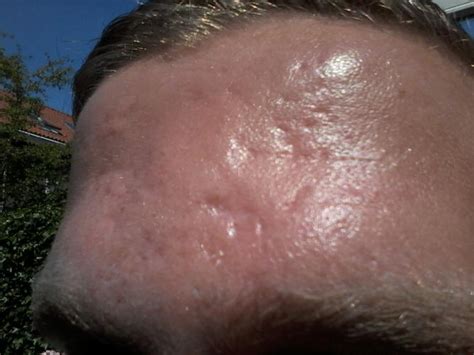 Forehead Scars, Help Me Identify + Treat Them – Scar treatments – Acne.org Forum