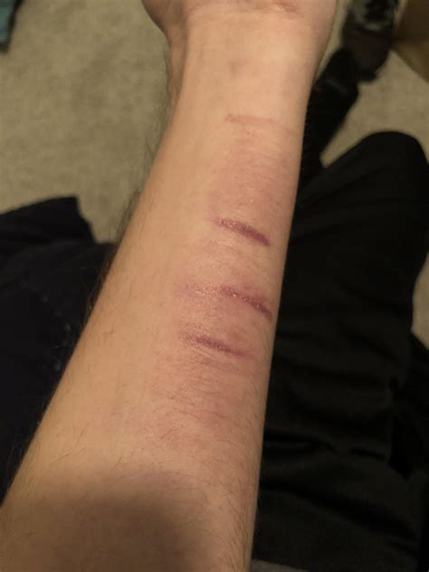 Haven’t cut my arm in a week :) but have cut in other places less ...