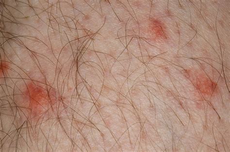Insect bites and stings - Symptoms - NHS