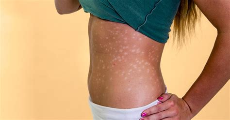 Guttate Psoriasis: Pictures, Causes, Treatment, and More