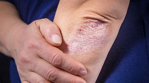 Scabies Rash: What Is a Scabies Rash?
