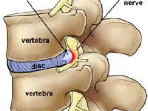 How to Treat a Bulging Disc in Your Lower Back | Middletown, CT Patch