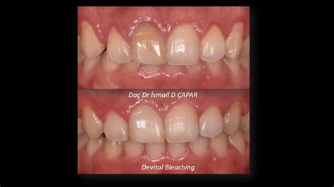 Step by Step Internal Non Vital Endodontic Bleaching /Adım Adım ...