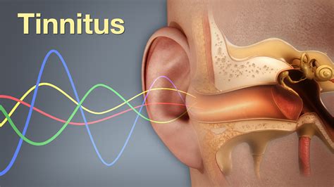 Tinnitus shown and explained using medical animation still shot