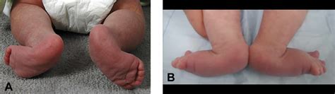 Congenital vertical talus causes, symptoms, diagnosis, treatment & prognosis