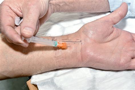 Carpal tunnel syndrome treatment - Stock Image - C029/7288 - Science Photo Library