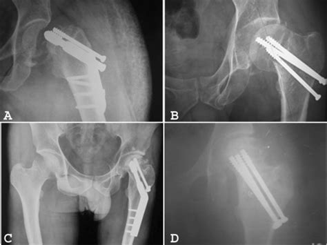 A: Cutting through of the sliding hip screw from the femoral neck at 6... | Download Scientific ...