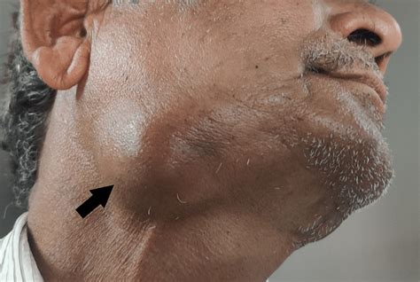 A Rare Case of Primary Squamous Cell Carcinoma of the Submandibular ...