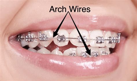 All About Orthodontic Arch Wires - ArchWired