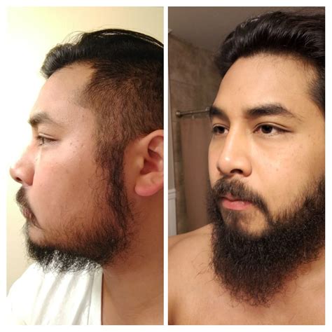 Minoxidil Beard Before And After Pictures For a lot of men growing a beard certainly isn t easy