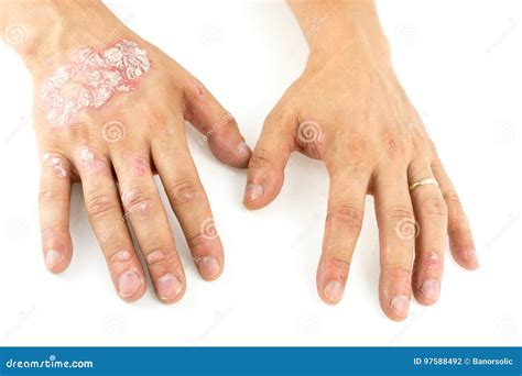 Psoriasis Vulgaris On The Mans Hands With Plaque, Rash And Patches On Skin. Autoimmune Genetic ...