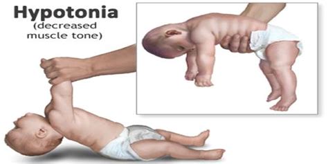 Hypotonia - Assignment Point