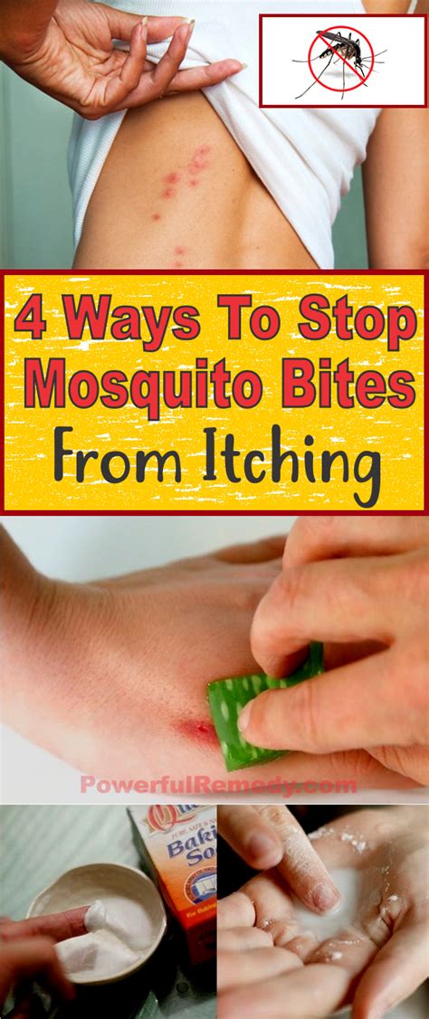 4 Ways to Stop Mosquito Bites from Itching | Insect bite remedy, Natural mosquito bite remedy ...