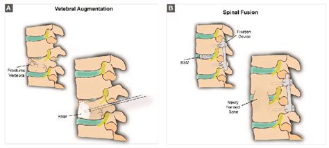 Schematic representation of (A) a vertebral augmentation procedure and... | Download Scientific ...