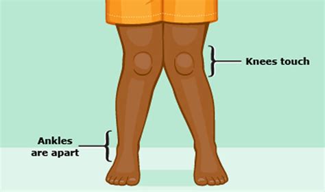 Genu valgum definition, causes, symptoms, diagnosis, treatment & prognosis