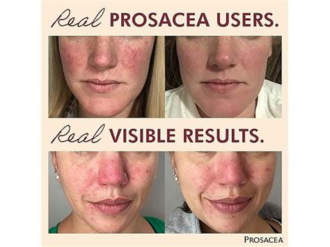 Prosacea Rosacea Gel