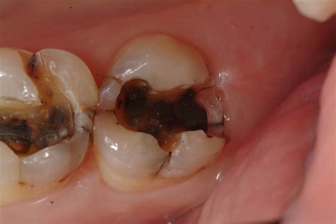 Managing Discolored Dentin - Lee Ann Brady DMD