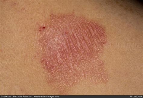 STOCK IMAGE, dermatology psoriasis a patch of pink dry and scaly skin on a 57 year old woman ...