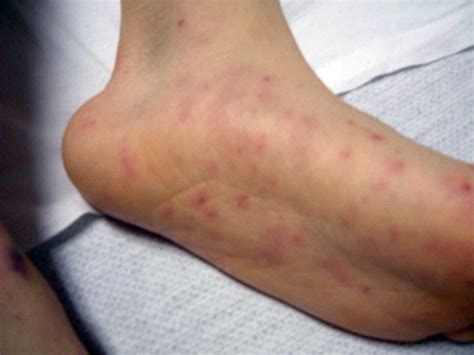 Meningococcal Disease: Causes, Symptoms & Treatment